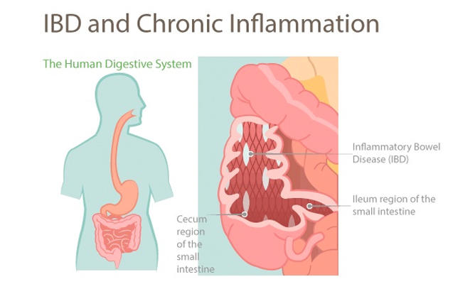ibd