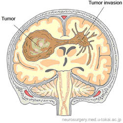 tumor