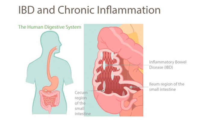 What are the treatment options for bowel inflammation?