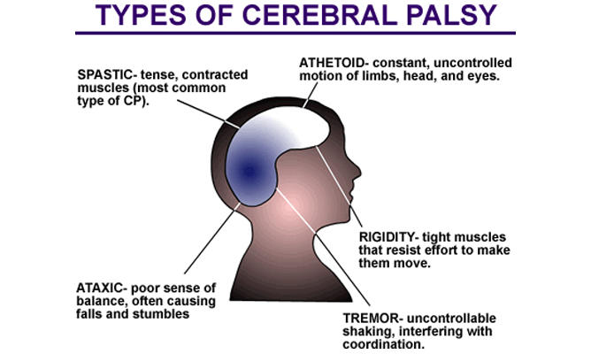 Studies Show Cannabis Effective Against Cerebral Palsy